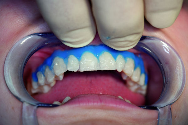 Teeth Whitening without light